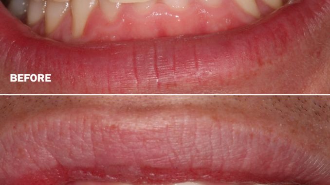 Composite Bonding (Veneers) in Turkey